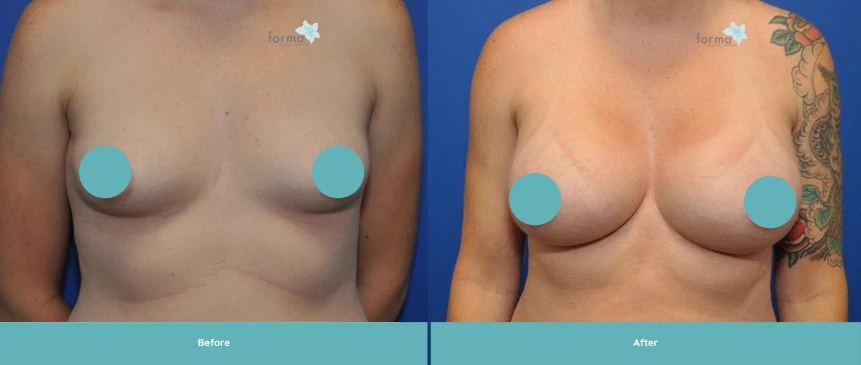 Woman's torso before and after breast augmentation surgery