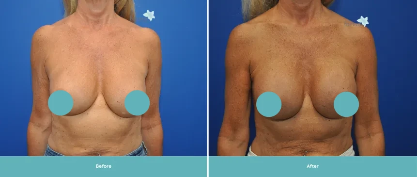 Before and after breast implant results showing front view comparison on blue background