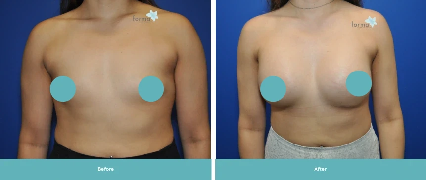 Before and after breast augmentation results, labeled before on left and after on right