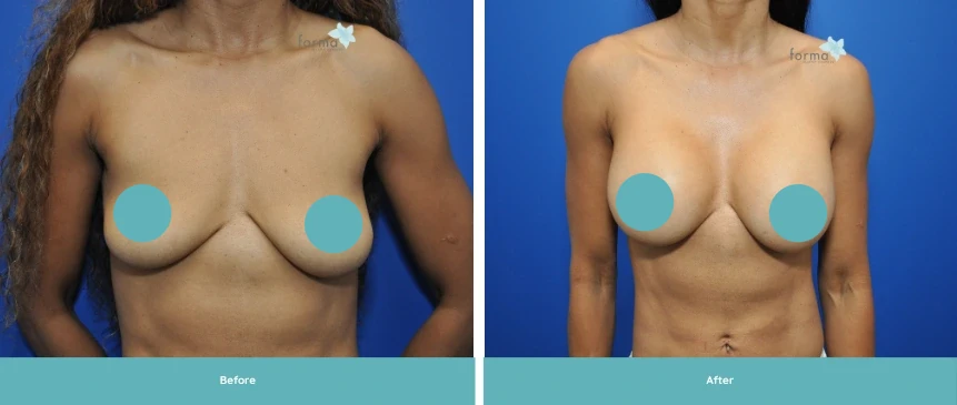 Before and after breast augmentation results, labeled before on left and after on right
