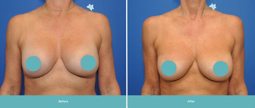 Breast augmentation before and after comparison, frontal view