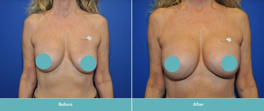 Breast implant exchange before and after results displaying improved fullness and symmetry