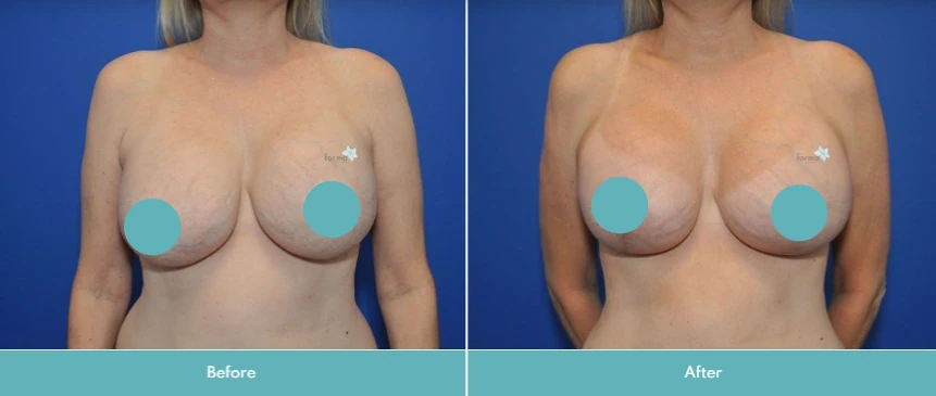 Breast implant exchange before and after demonstrating improved projection and symmetry
