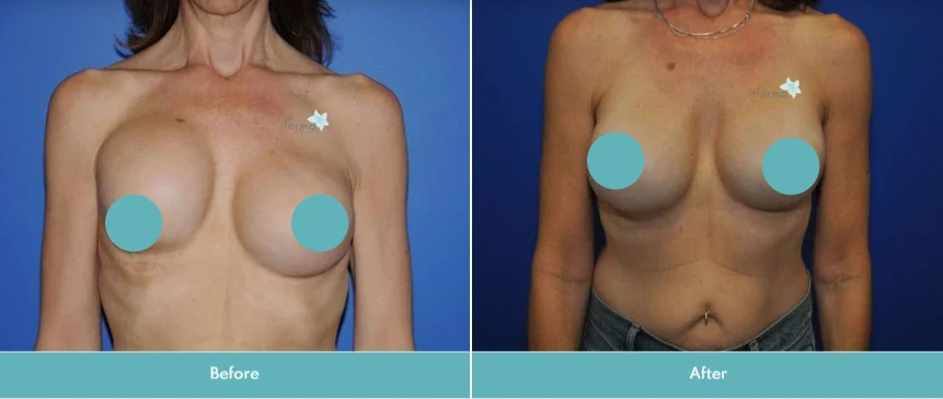 Breast implant exchange before and after comparison showing enhanced shape and contour