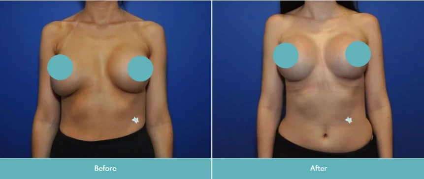 Breast implant exchange before and after, frontal view showing size and shape change