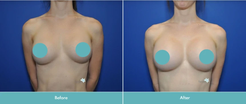 Breast implant exchange before and after, frontal view with revised implant proportions