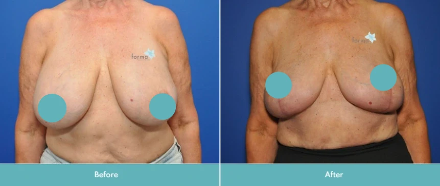 Before and after breast implant removal, showing chest from front view