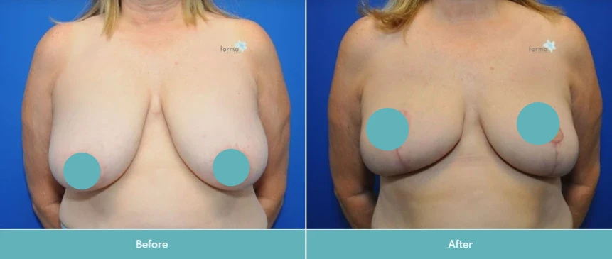 Breast implant removal before and after comparison, frontal view