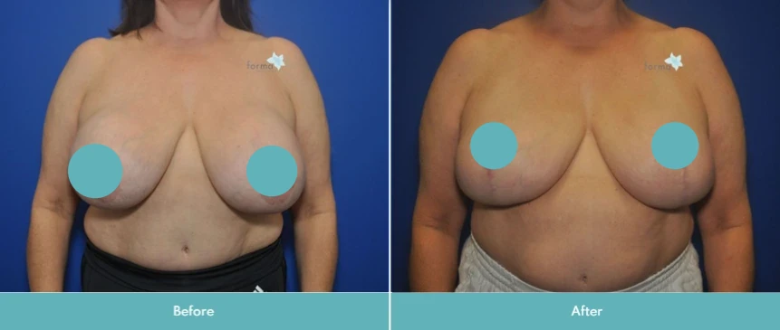 Before and after breast implant removal, showing chest from front view