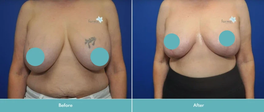 Before and after breast implant removal, showing chest from front view
