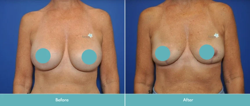 Before and after breast implant removal, showing chest from front view