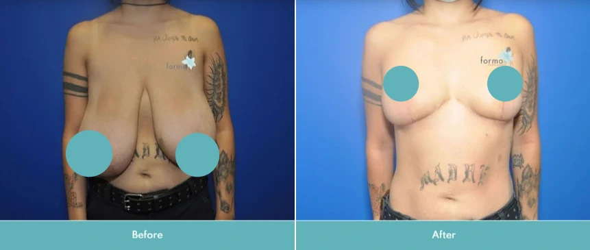 Breast reduction before and after comparison on tattooed patient showing reduced volume and lift