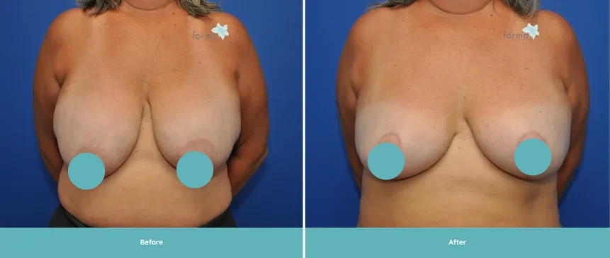 Woman's torso before and after breast reduction surgery