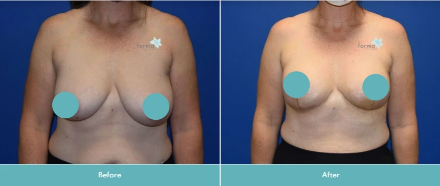 Breast reduction before and after comparison showing reduced volume and lifted appearance