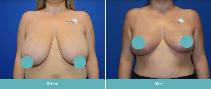 Breast reduction before and after comparison showing decreased breast size and improved symmetry