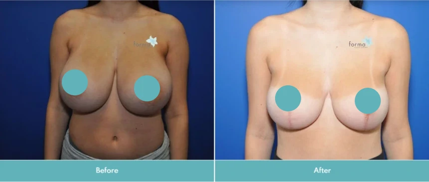 Breast reduction before and after comparison showing reduced breast size and improved contour