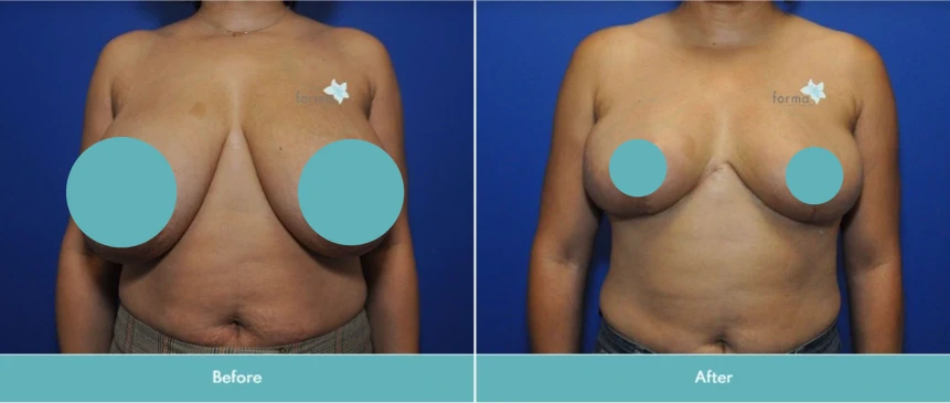 Breast reduction before and after, frontal view showing significant volume reduction and lift