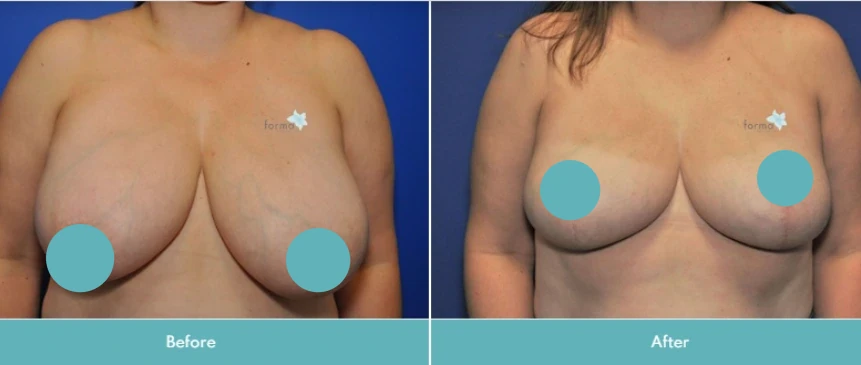 Breast reduction before and after, frontal view with reduced size and enhanced breast definition