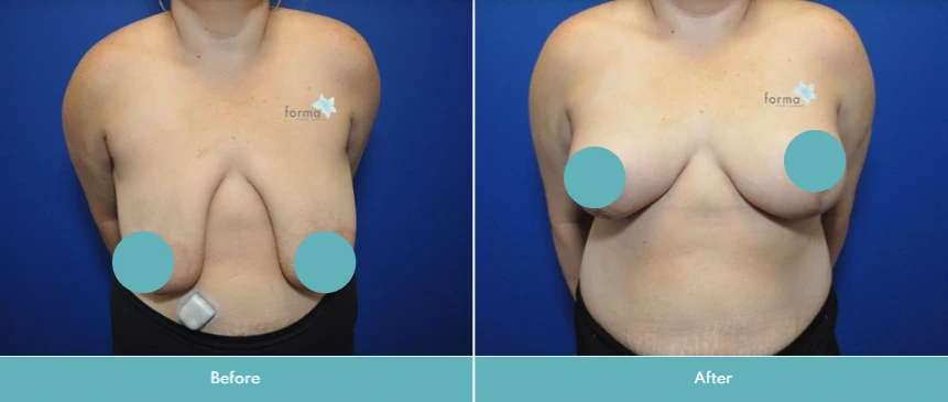 Breast reduction before and after, frontal view with improved breast shape and positioning