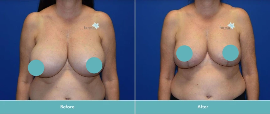 Breast reduction before and after comparison showing reduced breast tissue and perkier contour