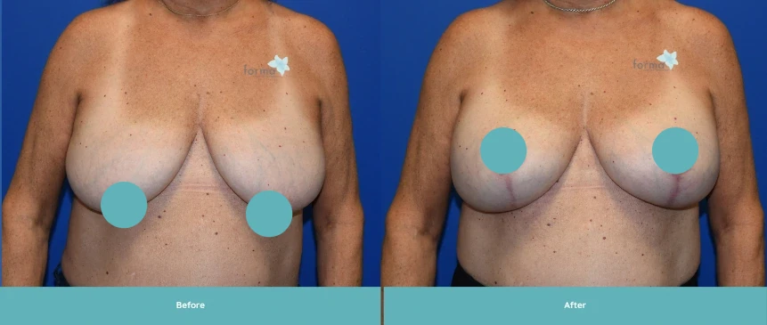 Breast augmentation and mastopexy before and after frontal comparison by Dr. Yao