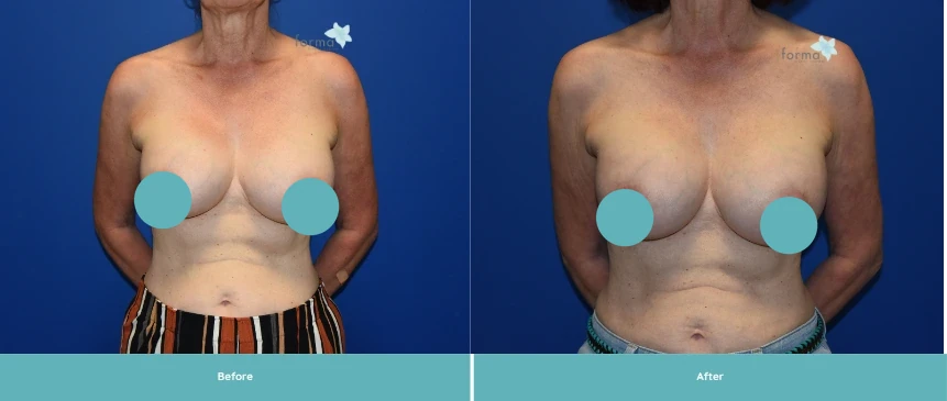 Before and after breast implant exchange by Dr. Yao