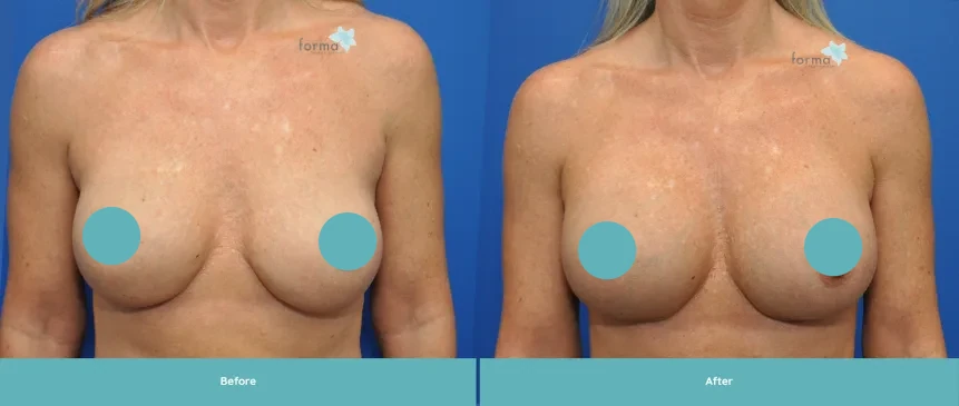 Woman's torso before and after breast implant exchange procedure
