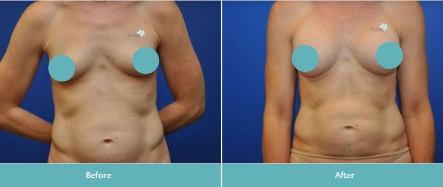 Female patient frontal view before and after breast surgery showing improved symmetry
