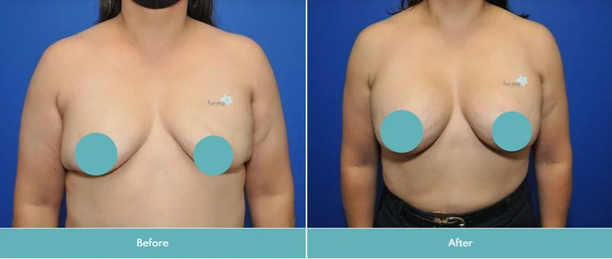 Female patient frontal view before and after breast surgery showing change in shape and position