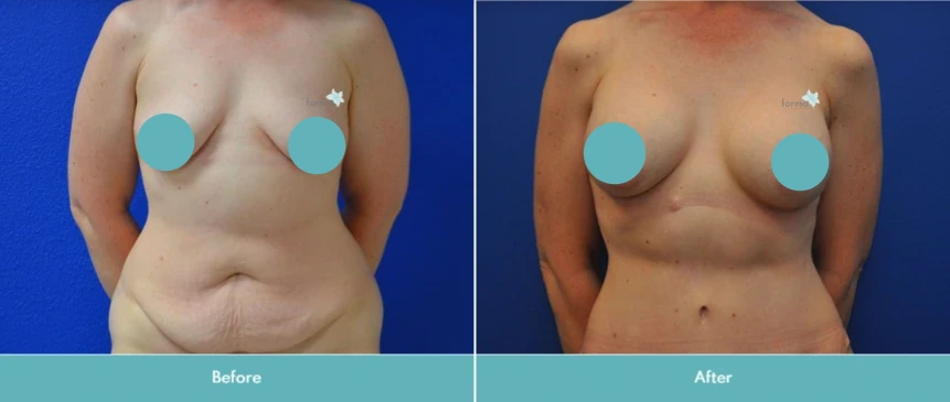Before and after breast lift showing improved breast shape and elevation