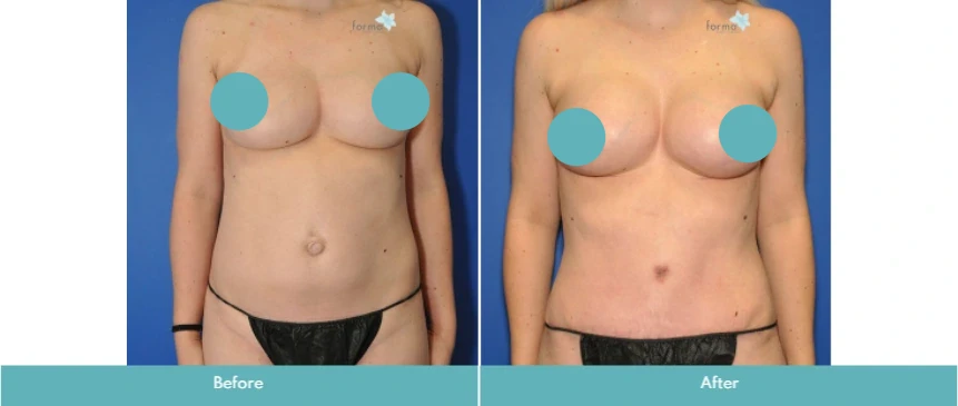 Before and after breast augmentation showing increased breast fullness and projection
