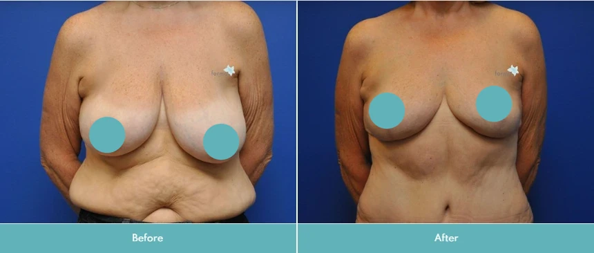 Before and after breast lift showing improved breast position and contour