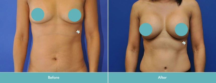 Before and after breast augmentation showing increased breast volume and improved fullness