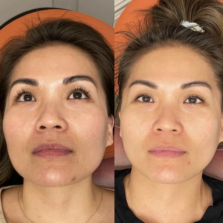 Before and After Gallery: Microneedling Banner
