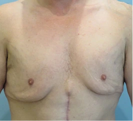 Gynecomastia Surgery Before and After Case 2