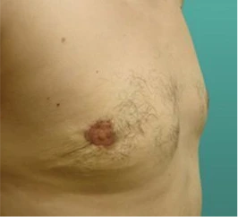 Gynecomastia Surgery Before and After Case 3