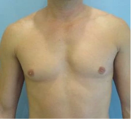Gynecomastia Surgery Before and After Case 6