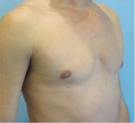 Gynecomastia Surgery Before and After Case 6