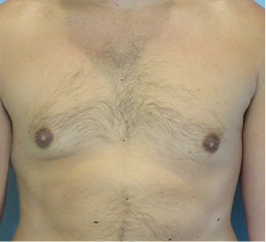 Gynecomastia Surgery Before and After Case 8