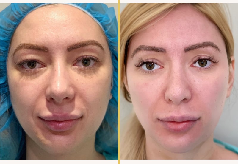 buccal fat 284m