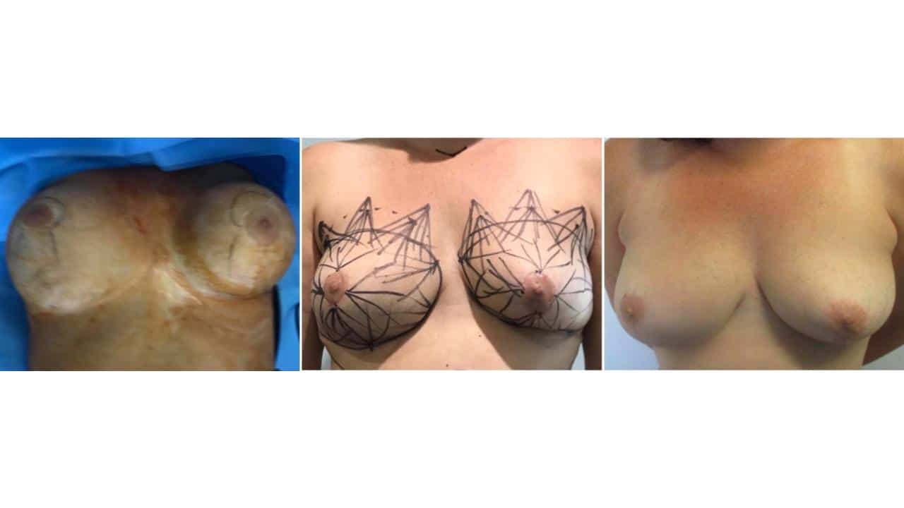 Breast Revision.pptx 15