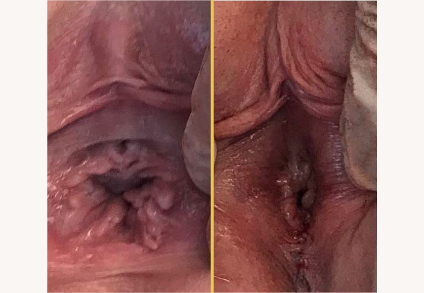 Case 0435