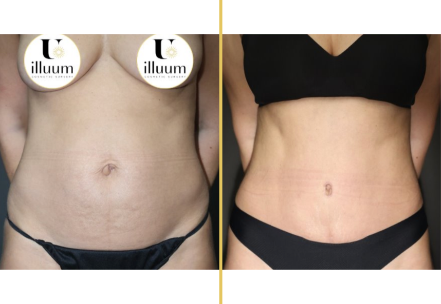 Before and after full abdomen and torso contouring, frontal view with reduced skin laxity