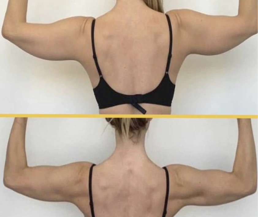 What Is Arm Liposuction? Banner