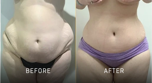 Before & After Gallery Tummy Tuck Banner