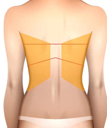 What Is an Upper Body Lift? Banner