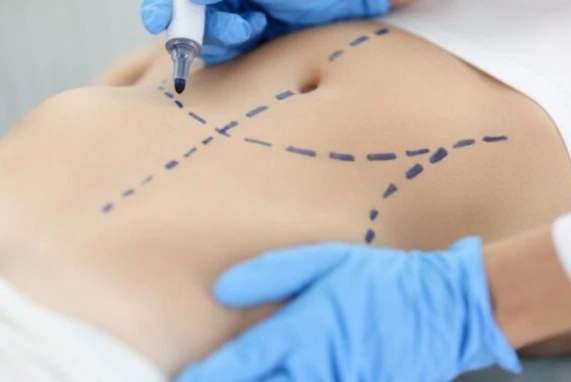 How Does Liposuction Work? Banner