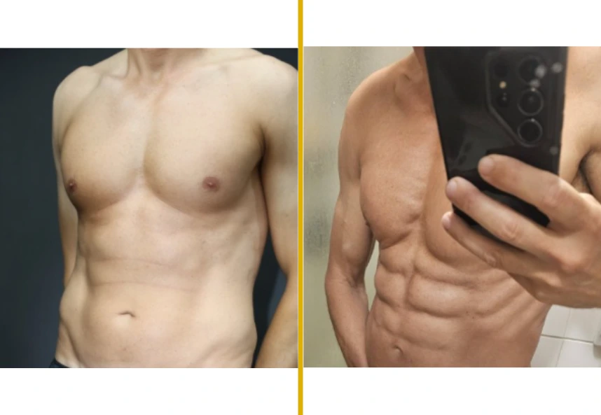 Before and After Gallery: Gynecomastia