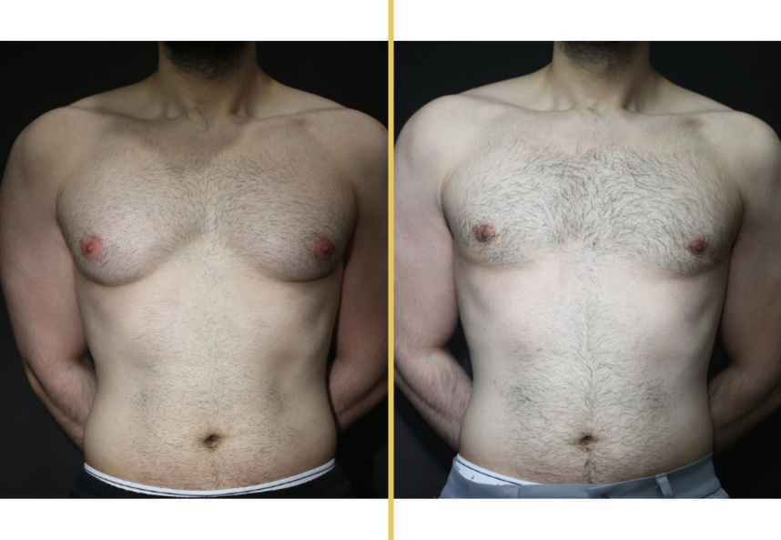 Gynecomastia Case 1037 before and after chest surgery results, front view
