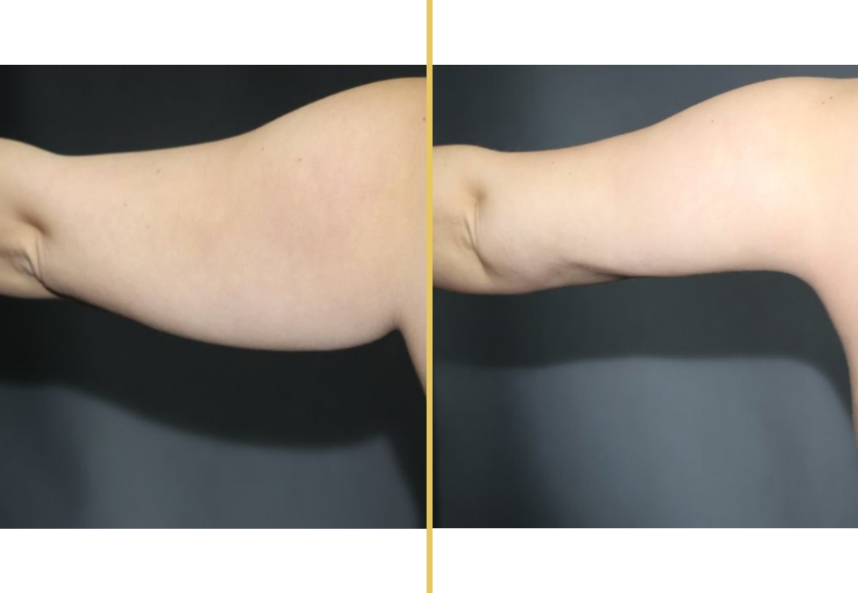 Before and after arm liposuction results showing improved contour and reduced fullness